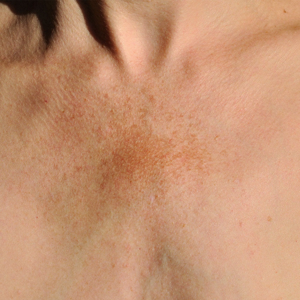 HYPERPIGMENTATION